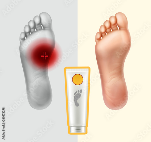 Healthy and painful soles