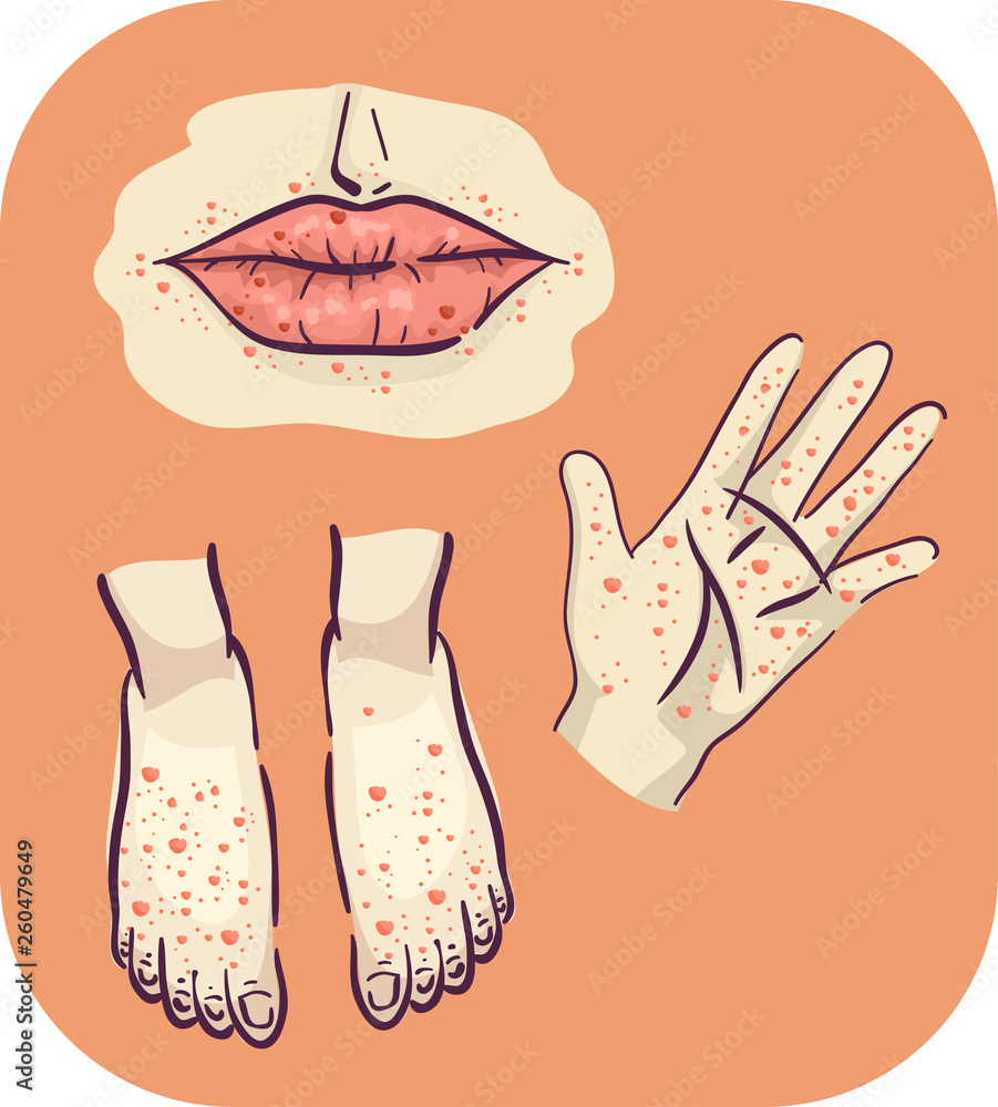 Symptoms Hand Feet Mouth Rashes Illustration Stock Vector Adobe Stock