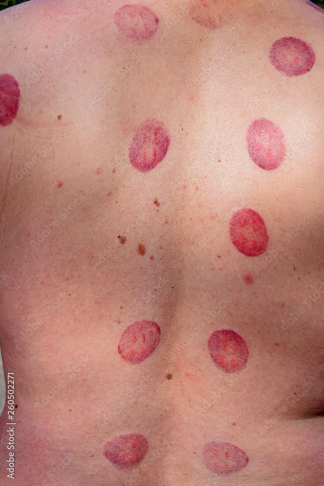 Fototapeta premium Skin after traditional cupping therapy. Vertical image.