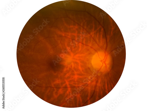 Retina of diabetes , diabates retinopathy,photo Medical Retina Abnormal isolated on white background.Saved with clipping path photo