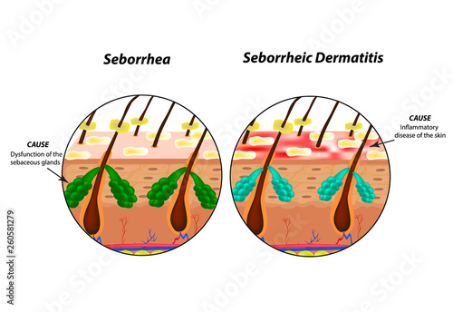 Causes Seborrhea skin and hair. Dandruff seborrheic dermatitis. Eczema. Dysfunction of the sebaceous glands. Inflammatory skin disease. Anatomical structure. Infographics. Vector illustration