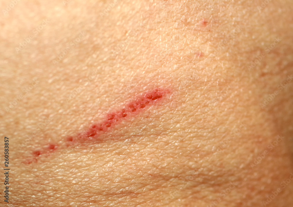 Fototapeta premium Wound cut on the skin. Abrasion on human skin.