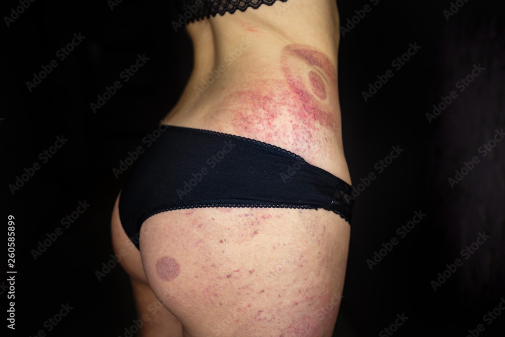 Φωτογραφία A bruise on the body of a young girl, a woman with extensive hematoma after a massage, isolated on black background