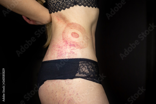 Slika na platnu A bruise on the body of a young girl, a woman with extensive hematoma after a massage, isolated on black background