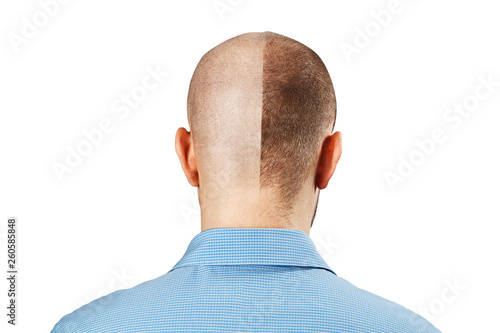 Portrait Man before and after hair loss, transplant on isolated white background. Split personality, Back view