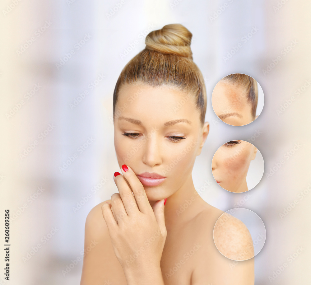 Dark spots, freckles,hyperpigmentation(melasma or chloasma) Dark spots, freckles,hyperpigmentation(melasma or chloasma)