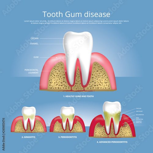 Human teeth Stages of Gum Disease Vector Illustration