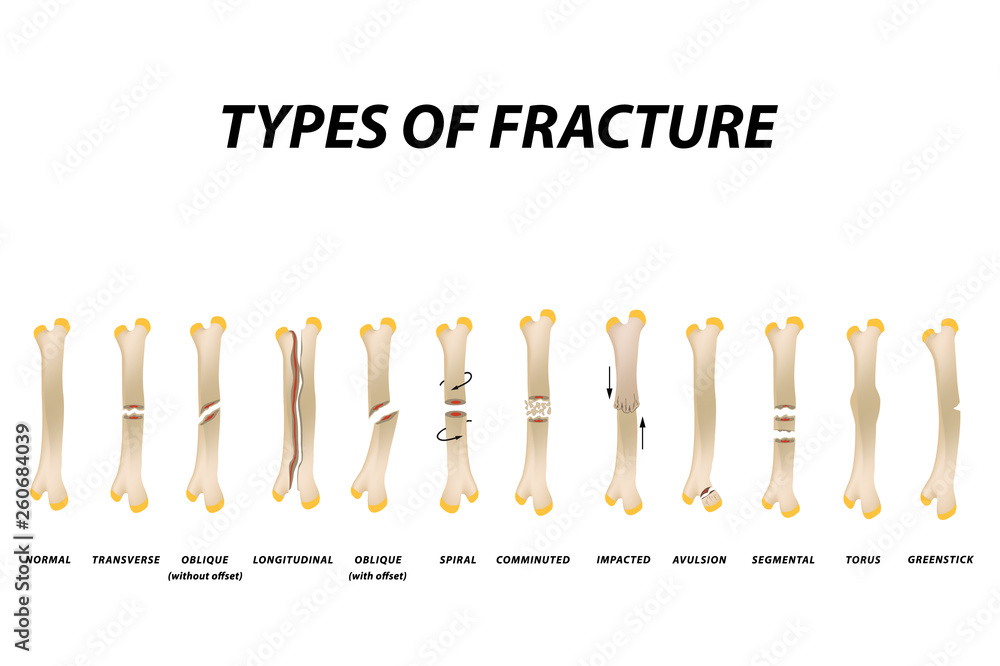 Types of fracture. Fracture bone set. Infographics. Vector illustration