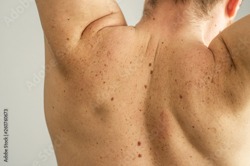 Close up detail of the bare skin on a man back with scattered moles and freckles. Checking benign moles. Sun effect on skin. Birthmarks on skin photo