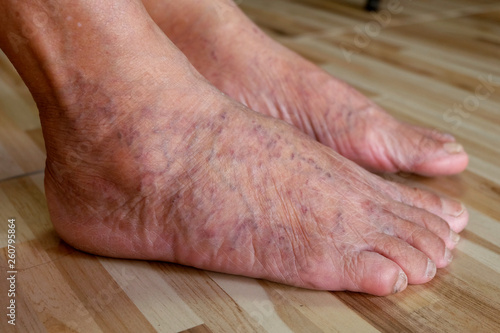 Close up varicose veins on the legs and feet of an Asian old woman © damrong
