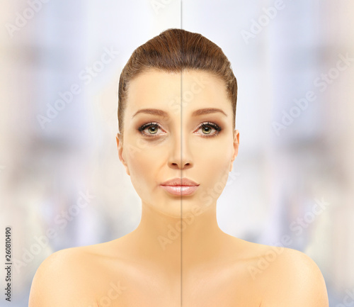 Aging, first signs of aging, appearance of lines,Injectable fillers for corrected variety of cosmetic concerns
