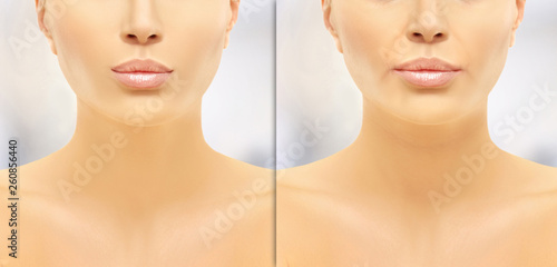 Nasolabial folds , first signs of aging, appearance of lines,Injectable fillers for corrected variety of cosmetic concerns