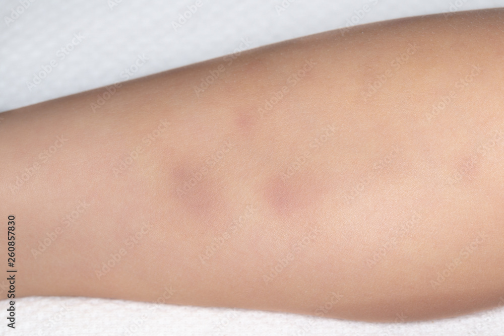 Bruises on the leg of a small child