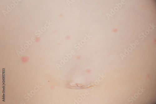 Itchy rash on the belly of a young toddler