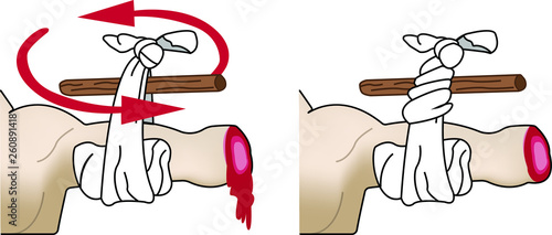 Torniquete amputación brazo