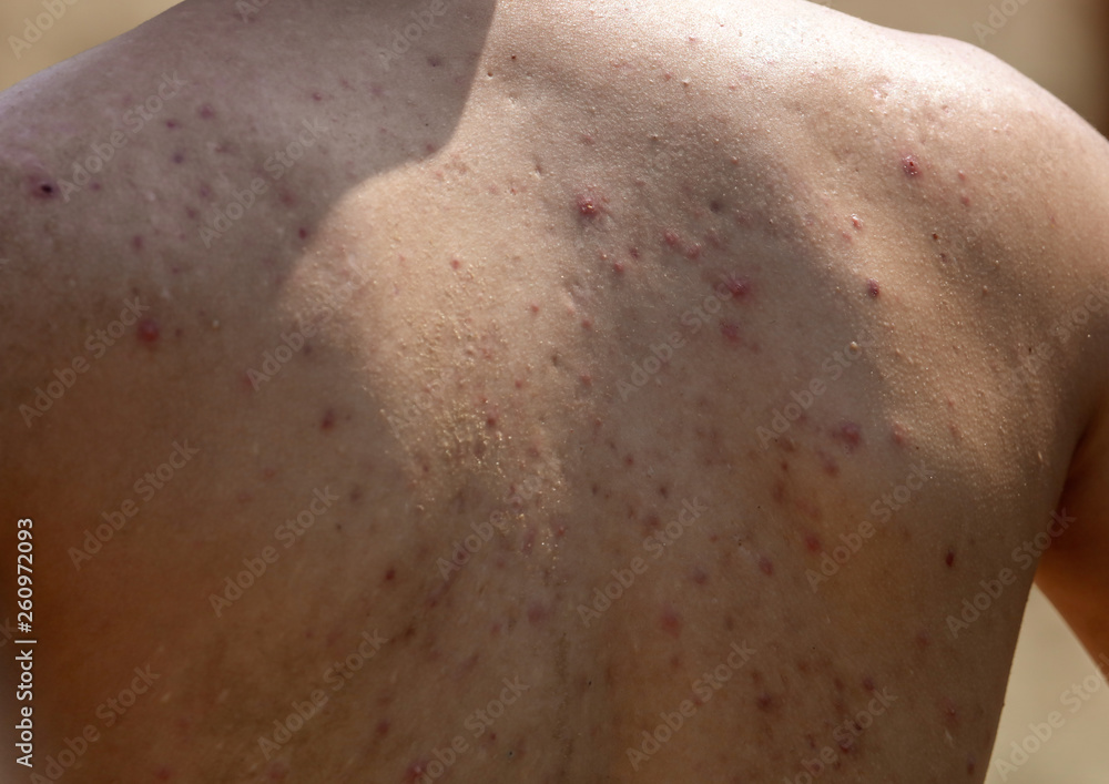 Man with acne on his back