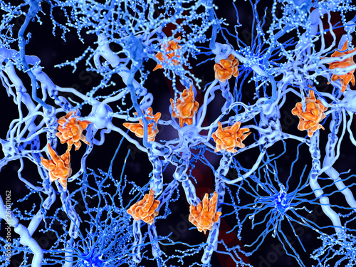 Foto Multiple sclerosis (MS): microglia cells damage the myelin sheath of neuron axons