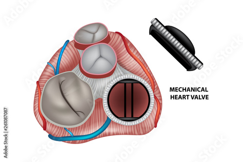 Circular mechanical (artificial) valve inside heart.