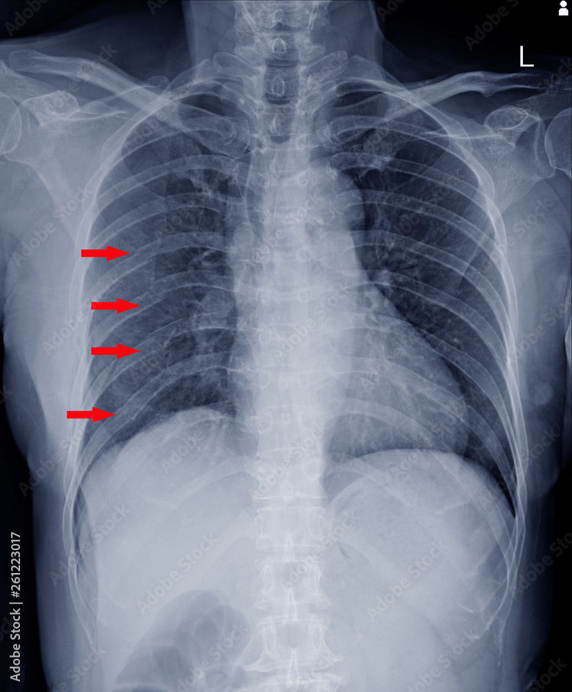 xray chest.finding Multiple fracture ribs on red arrows mark. Stock