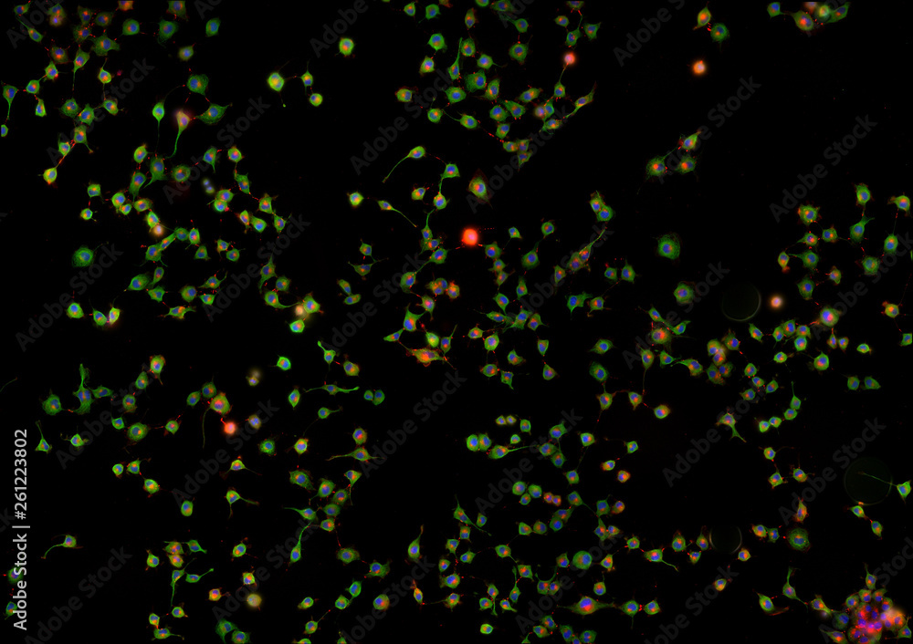 Real fluorescence microscopic view of cancer cells - human melanoma ...