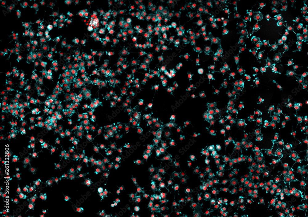 Real fluorescence microscopic view of cancer cells - human melanoma Real fluorescence microscopic view of cancer cells - human melanoma