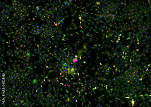 Real fluorescence microscopic view of cancer cells - human melanoma