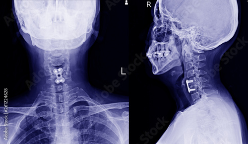 X-ray C-SPINES show post operation internal fixation C4-C5 & C6 with plate & screws red mark and There is hypersignal intensity lesion in the spinal cord at C4 to C6 levels