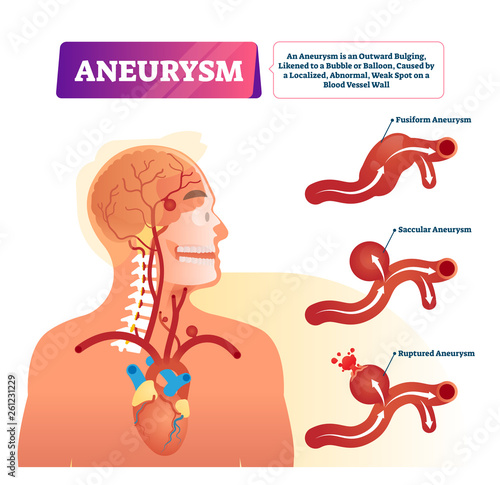 Aneurysm vector illustration. Labeled medical outward bulging vessel scheme photo