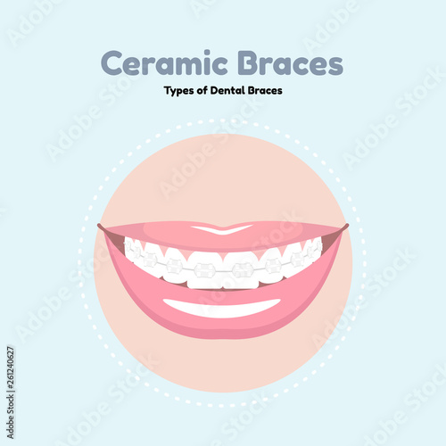 Ceramic Dental Braces. Types of Dental Braces. Vector flat illustration of smile with braces on the teeth.