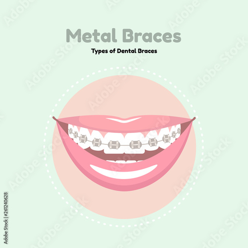 Metal Dental Braces. Types of Dental Braces. Vector flat illustration of smile with braces on the teeth.