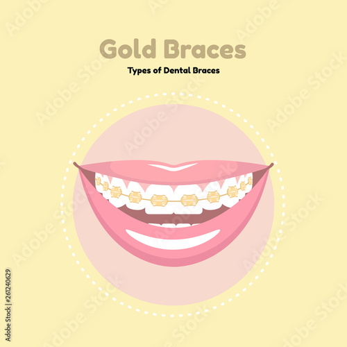 Gold Dental Braces. Types of Dental Braces. Vector flat illustration of smile with braces on the teeth.