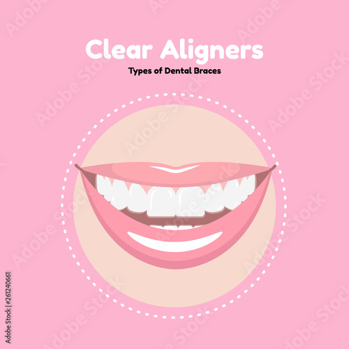 Clear Dental Alighers. Types of Dental Braces. Vector flat illustration of smile with alighers on the teeth.