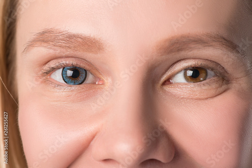 Eyes of the girl close up and in one blue contact lens