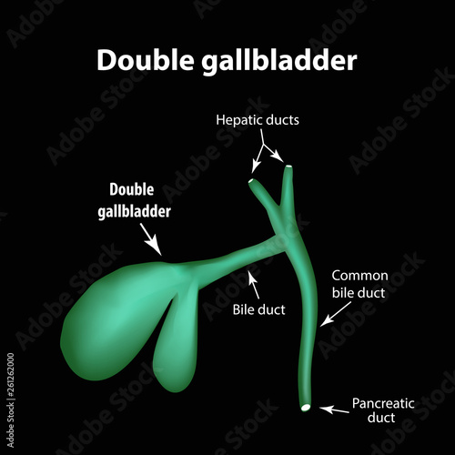 Double gall bladder. Pathology of the gallbladder. Cholecystitis. The structure of the gallbladder. Infographics. Vector illustration photo