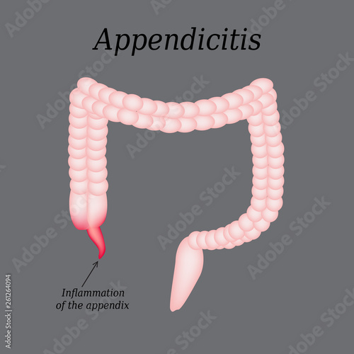 Appendicitis. Inflammation of the appendix. Colon. The illustration on a gray background