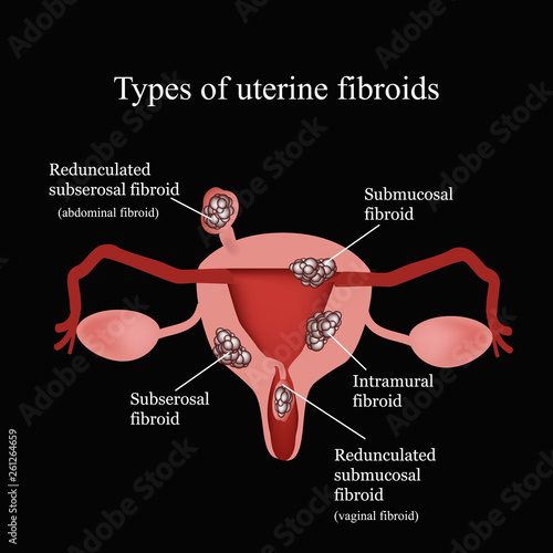 Types of uterine fibroids. Endometriosis. Infographics. Vector illustration on a black background