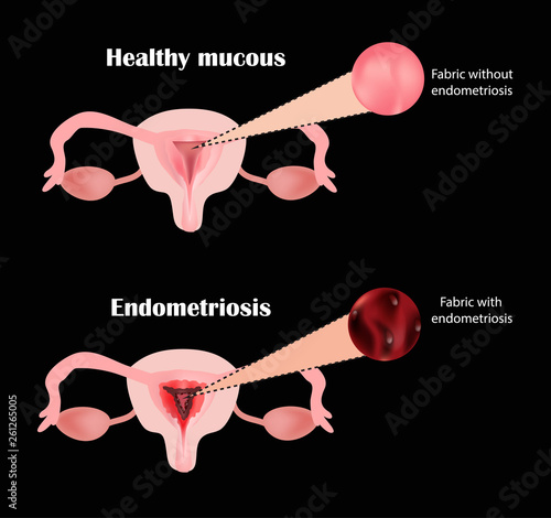 Endometriosis. The structure of the pelvic organs. Adenomyosis. The endometrium. Vector illustration