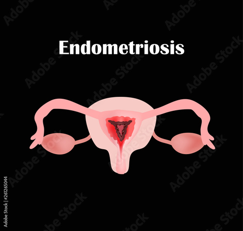 Endometriosis. The structure of the pelvic organs. Adenomyosis. The endometrium. Vector illustration
