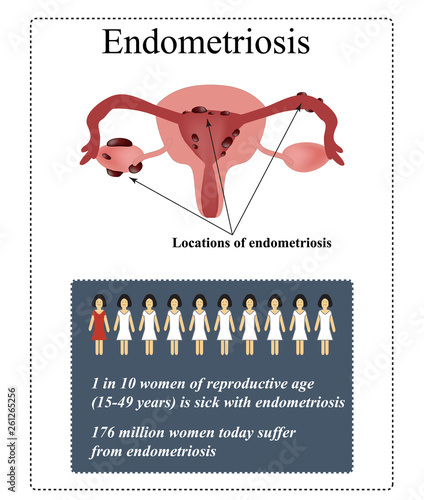 Endometriosis. Endometrial cysts. Vector illustration on isolated