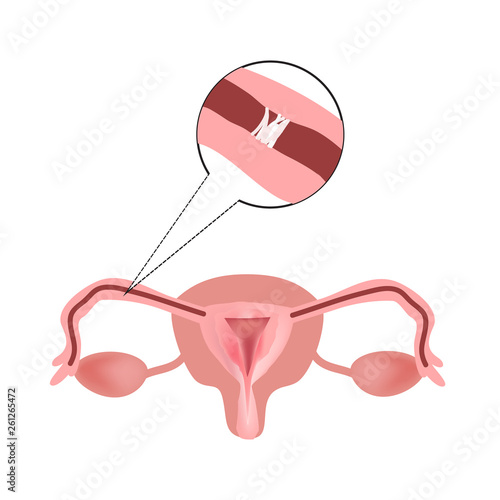 Obstruction of the fallopian tubes. The structure of the pelvic organs. Infographics. Vector illustration on isolated background photo