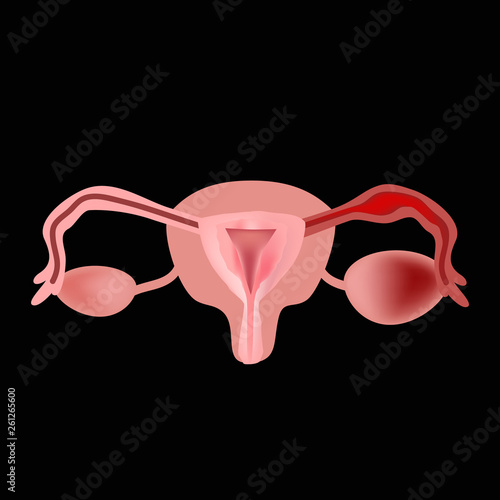 Salpingitis. Inflammation of the fallopian tube. Oophoritis.   the ovary. pelvic organs. Infographics Vector illustration photo