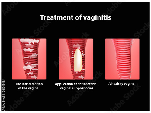 Treatment of vaginitis suppositories. inflammation the vagina. Infographics. vector illustration