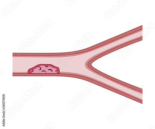Thrombosis Blood Vessel
