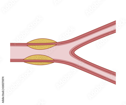 Vasculitis. Destroy Blood Vessels