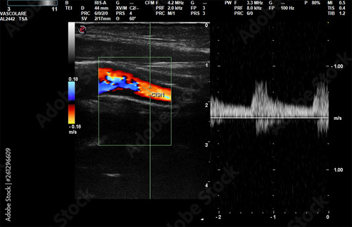 Ecodoppler ultrasound imaging diagnostic video screen
