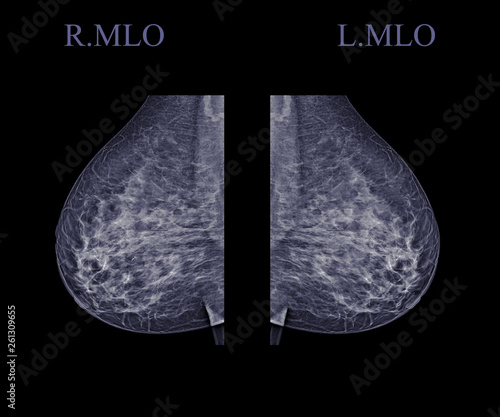 Foto X-ray Digital Mammogram  or mammography  both side of the breast  MLO view  for finding Breast cancer in women