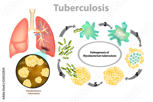 Tuberculosis (TB). Progression of pulmonary tuberculosis - Mycobacterium tuberculosis (MTB) bacteria