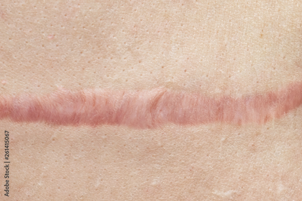 © ReaLiia - Close up of cyanotic keloid scar caused by surgery and suturing, skin imperfections or defects. Hypertrophic Scar on skin, dermatology and cosmetology concept