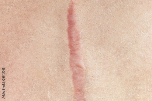Fototapeta Close up of cyanotic keloid scar caused by surgery and suturing, skin imperfections or defects