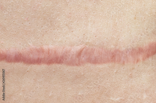 Fotografia Close up of cyanotic keloid scar caused by surgery and suturing, skin imperfections or defects